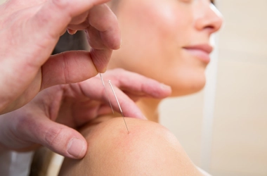 Acupuncture Flower Mound TX Acupuncture Shoulder Acupuncture on a patients shoulder.